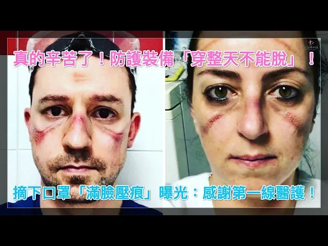 真的辛苦了!防護裝備「穿整天不能脫」!摘下口罩「滿臉壓痕」曝光: 感謝第一線醫護!